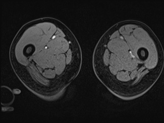 File:Closed loop small bowel obstruction in pregnancy (MRI) (Radiopaedia 87637-104031 G 61).jpg