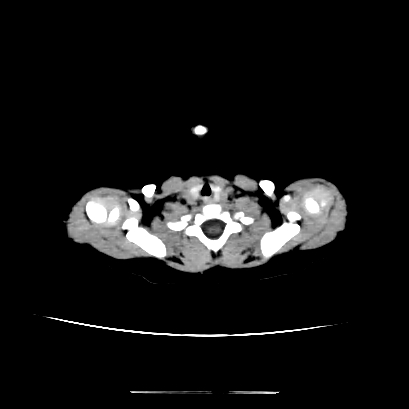 Cloverleaf skull (Radiopaedia 91901-109710 Axial non-contrast 8).jpg