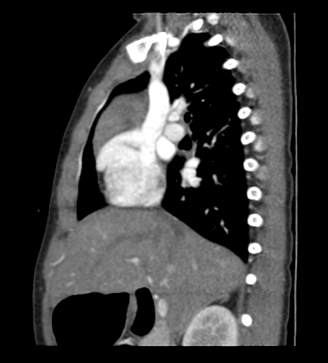 File:Coarctation of aorta (Radiopaedia 27427-27622 Sagittal C+ CTPA 42).png