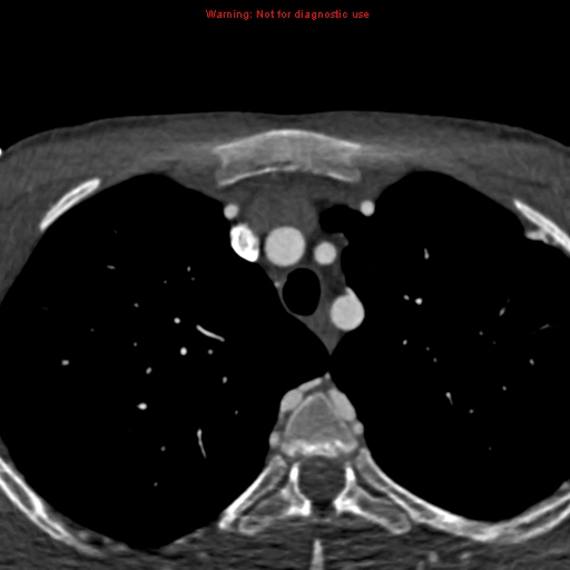 File:Coarctation of the aorta (Radiopaedia 12461-12697 A 1).jpg
