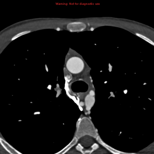 File:Coarctation of the aorta (Radiopaedia 12461-12697 A 121).jpg