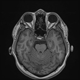 File:Cochlear incomplete partition type III associated with hypothalamic hamartoma (Radiopaedia 88756-105498 Axial T1 77).jpg