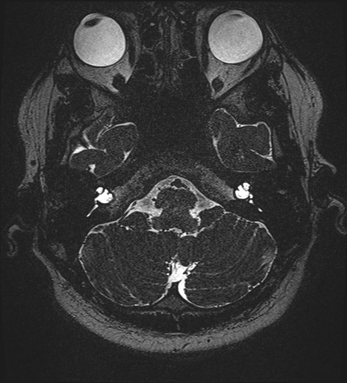 Cochlear incomplete partition type III associated with hypothalamic hamartoma (Radiopaedia 88756-105498 Axial T2 59).jpg