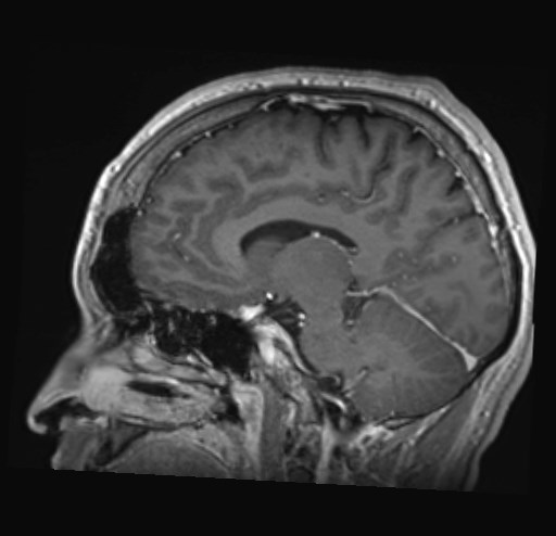 Cochlear incomplete partition type III associated with hypothalamic hamartoma (Radiopaedia 88756-105498 Sagittal T1 C+ 24).jpg