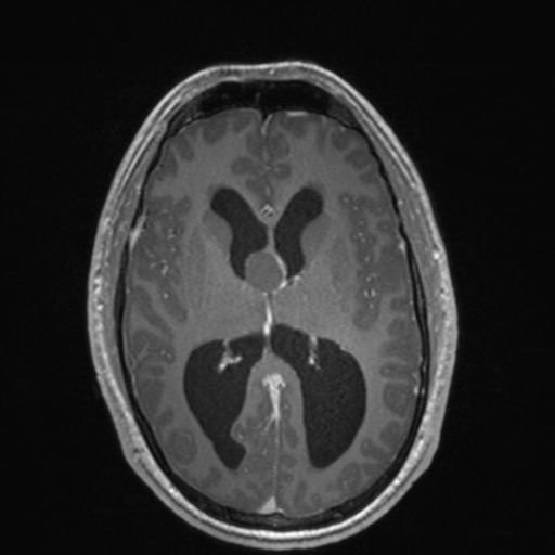 File:Colloid cyst (Radiopaedia 44510-48181 Axial T1 C+ 97).png