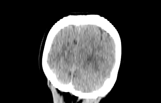 Colloid cyst (Radiopaedia 88663-105373 Coronal non-contrast 60).jpg