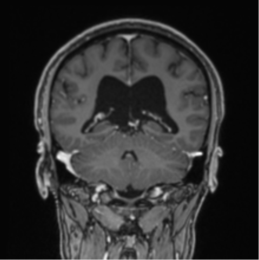 File:Colloid cyst of the third ventricle (Radiopaedia 86571-102662 Coronal T1 C+ 36).png