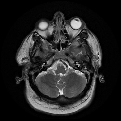 File:Colloid cyst with anterior communicating artery aneurysm (Radiopaedia 33901-35091 Axial T2 5).jpg
