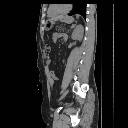 File:Colocutaneous fistula in Crohn's disease (Radiopaedia 29586-30093 C 37).jpg
