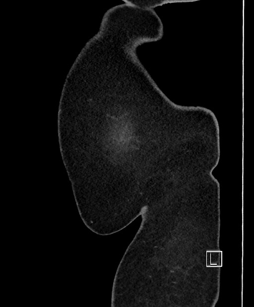 Colon adenocarcinoma (Radiopaedia 59374-66735 C 66).jpg