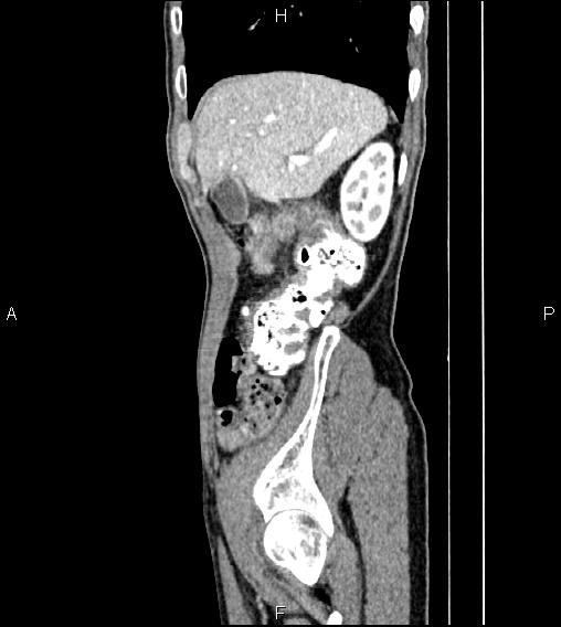 Colon adenocarcinoma - hepatic flexure (Radiopaedia 85635-101395 D 16).jpg
