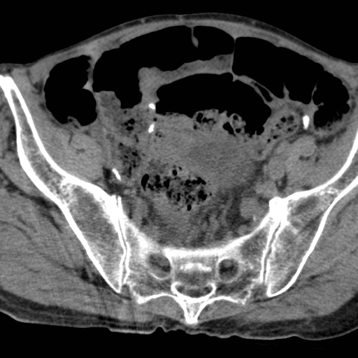 Colon cancer with calcified liver metastasis (Radiopaedia 74423-85309 Axial non-contrast 92).jpg