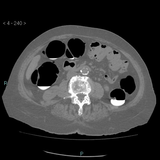 File:Colonic lipomas (Radiopaedia 49137-54244 Axial bone window 108).jpg
