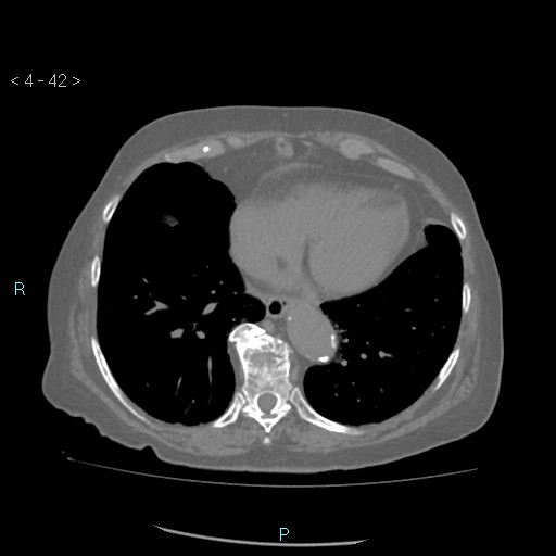 File:Colonic lipomas (Radiopaedia 49137-54244 Axial bone window 20).jpg