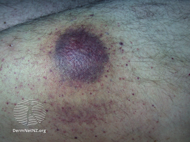 File:Cutaneous B-cell lymphoma (DermNet NZ dermal-infiltrative-lymphoma4).jpg