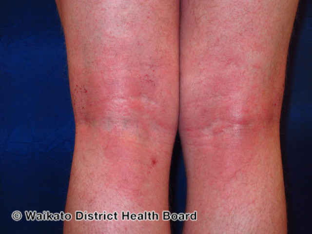 File:Flexural eczema (DermNet NZ dermatitis-w-atopic45).jpg
