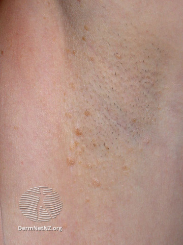 File:Fox-Fordyce disease (DermNet NZ hair-nails-sweat-fox-fordyce2).jpg