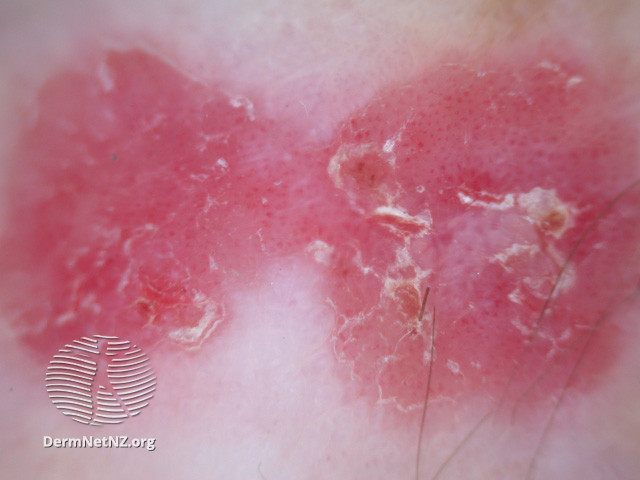 Intraepidermal carcinoma (DermNet NZ lesions-scc-in-situ-2954).jpg