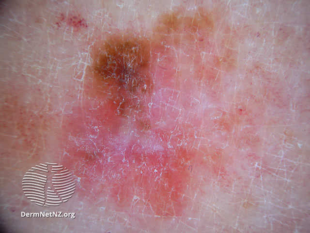 File:Milky pink areas (DermNet NZ doctors-dermoscopy-course-images-amelanotic4).jpg