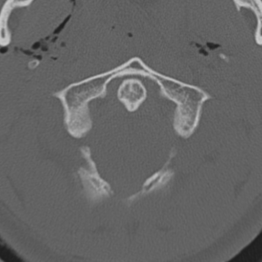 File:Multitrauma with diffuse axonal injury, temporal bone fractures and traumatic caroticocavernous fistula (Radiopaedia 37242-39035 Axial 219).png