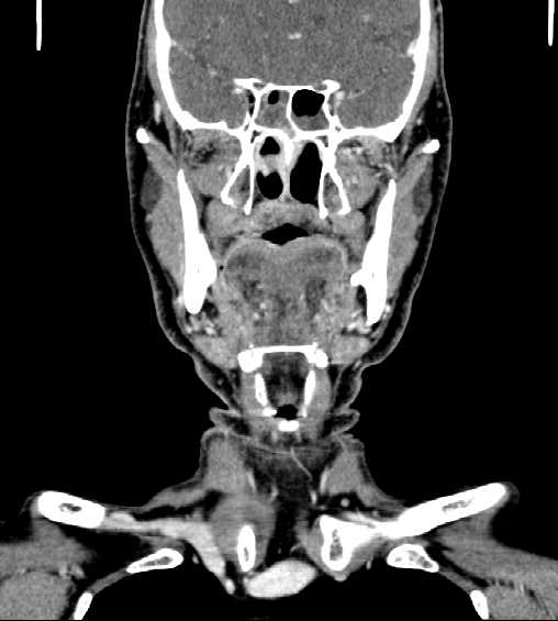 File:Nasopharyngeal carcinoma - infiltrating the clivus (Radiopaedia 62583-70875 D 15).jpg