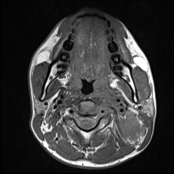 Nasopharyngeal carcinoma with skull base invasion (Radiopaedia 53415-59485 Axial T1 41).jpg