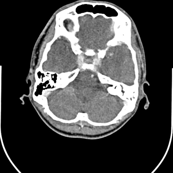 Nasopharyngeal carcinoma with skull base invasion (Radiopaedia 53415-59705 A 7).jpg