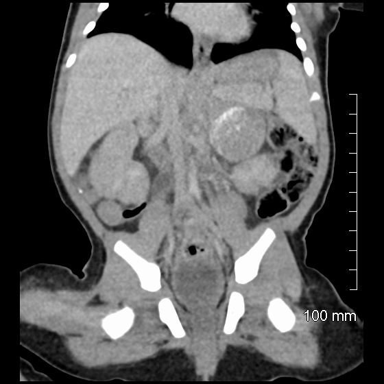 File:Neonatal neuroblastoma (Radiopaedia 56651-63438 Coronal non-contrast 30).jpg