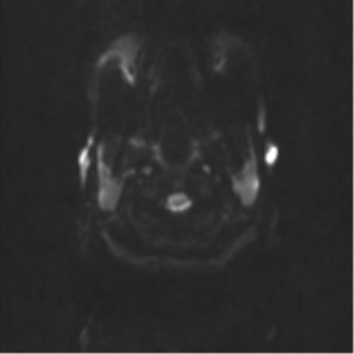 Neurenteric cyst (Radiopaedia 58641-65837 Axial DWI 36).png