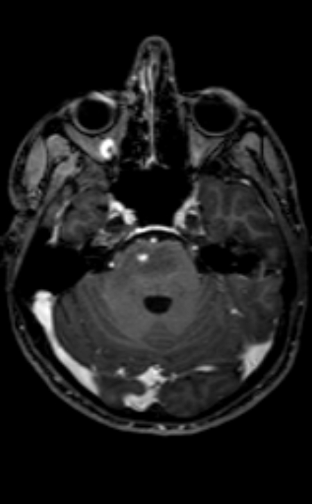 Neuro-Behçet disease (Radiopaedia 90112-107294 Axial T1 C+ 163).jpg
