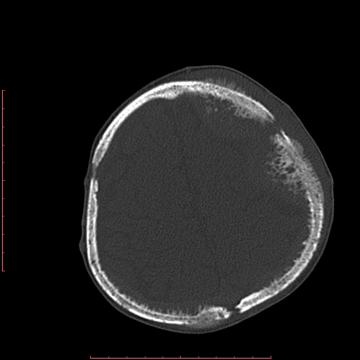 File:Neuroblastoma skull metastasis (Radiopaedia 56053-62683 Axial bone window 21).jpg