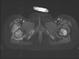 File:Neuroblastoma with bone metastases (Radiopaedia 67080-76414 Axial STIR 42).jpg