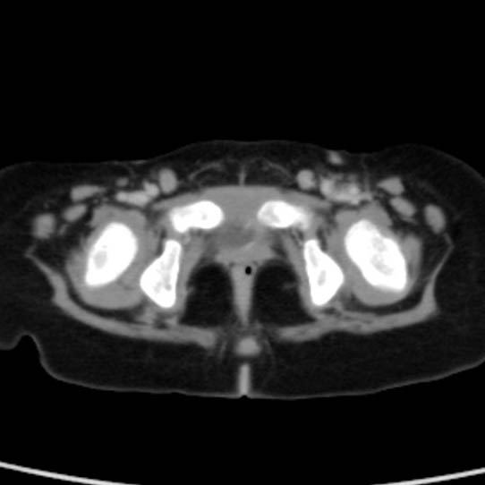 Neuroblastoma with skull metastases (Radiopaedia 30326-30960 C 61).jpg