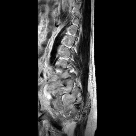 File:Neurofibromatosis type 1- extensive spinal involvement and Christmas tree sign (Radiopaedia 60610-68332 Sagittal T2 5).jpg