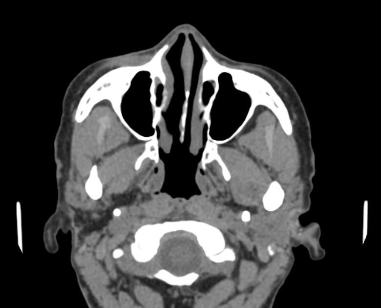 Neurofibromatosis type 1- orbital manifestations (Radiopaedia 49391-54511 Axial non-contrast 27).jpg