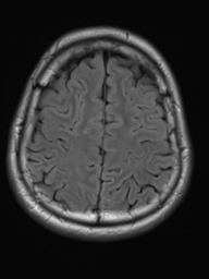 File:Neurofibromatosis type 2 (Radiopaedia 44936-48838 Axial FLAIR 19).png