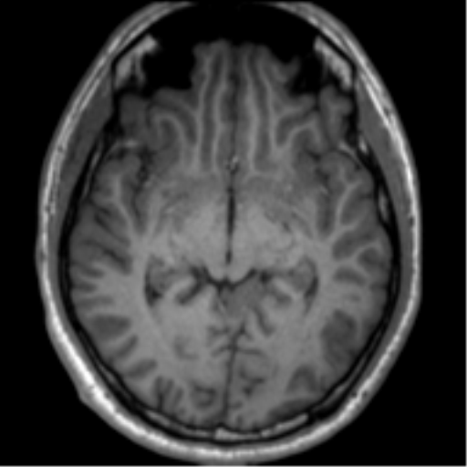 File:Neurofibromatosis type 2 (Radiopaedia 44936-48838 Axial T1 63).png