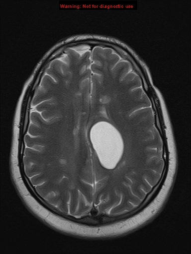 File:Neuroglial cyst (Radiopaedia 10713-11184 Axial T2 8).jpg