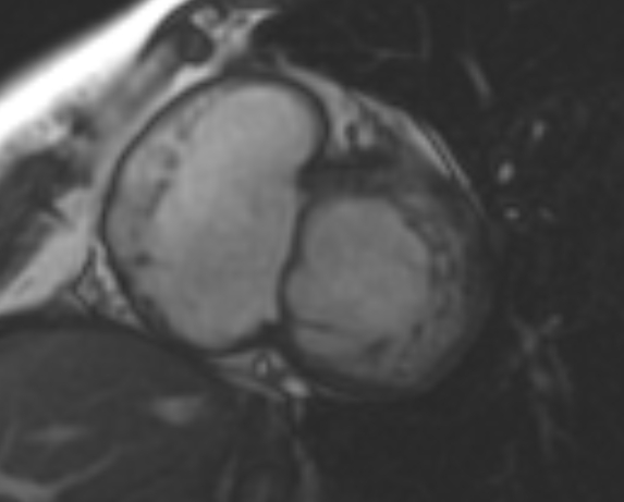 File:Non-compaction of the left ventricle (Radiopaedia 69436-79314 Short axis cine 161).jpg