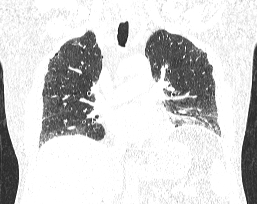 Non-specific interstitial pneumonia (NSIP) (Radiopaedia 68599-78228 Coronal lung window 45).jpg