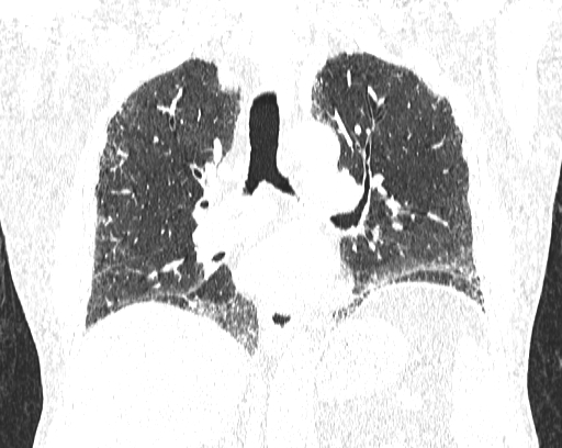 Non-specific interstitial pneumonia (NSIP) (Radiopaedia 68599-78228 Coronal lung window 53).jpg