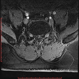Non Hodgkin's lymphoma with metastasis to spine (Radiopaedia 54844-61103 Axial T1 C+ fat sat 11).jpg