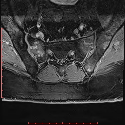 Non Hodgkin's lymphoma with metastasis to spine (Radiopaedia 54844-61103 Axial T1 C+ fat sat 28).jpg