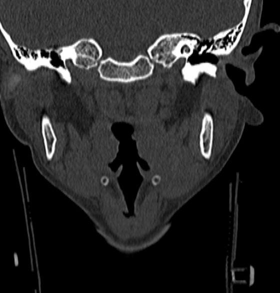 File:Normal CT cervical spine - 12-year-old (Radiopaedia 55352-61775 Coronal bone window 11).jpg