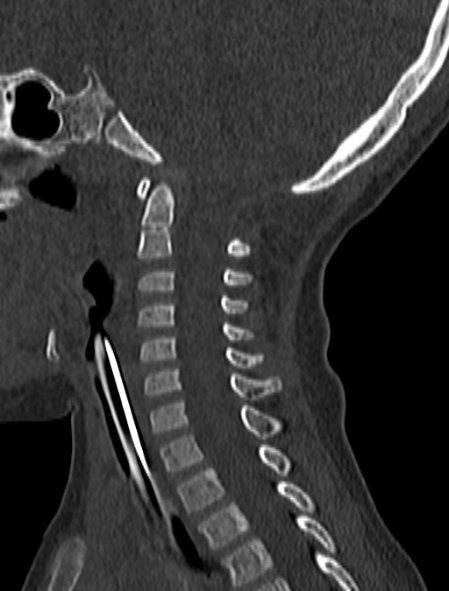 Normal CT cervical spine - pediatric (Radiopaedia 52549-58462 Sagittal bone window 111).jpg