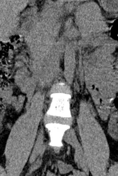 Normal CT lumbar spine (Radiopaedia 53981-60118 F 6).jpg