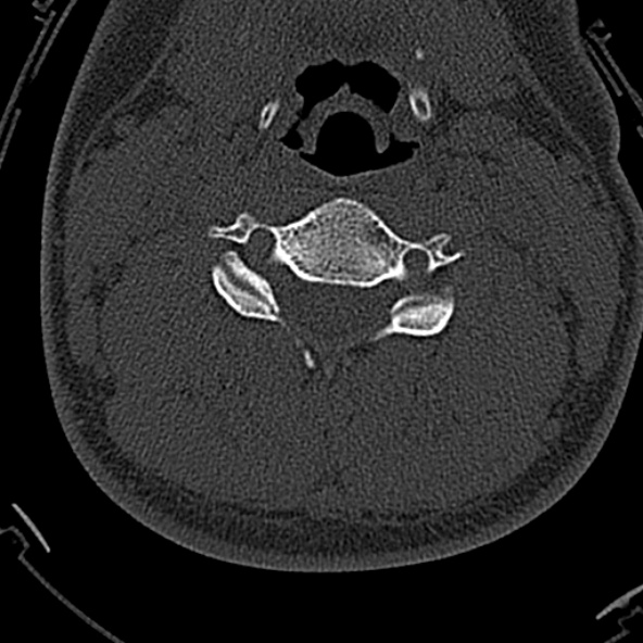 File:Normal CT of the cervical spine (Radiopaedia 53322-59305 Axial bone window 137).jpg