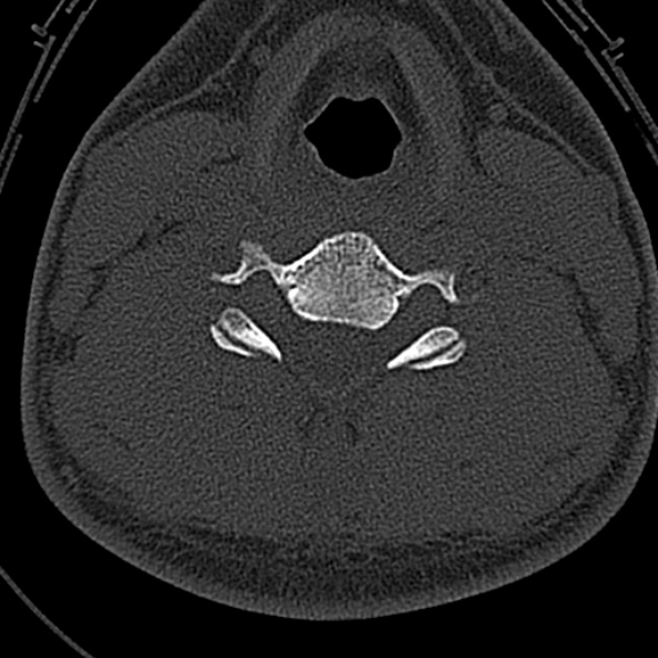 File:Normal CT of the cervical spine (Radiopaedia 53322-59305 Axial bone window 163).jpg