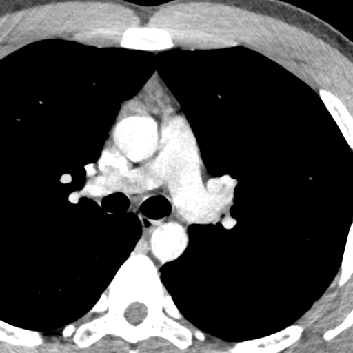 File:Normal CT pulmonary veins (pre RF ablation) (Radiopaedia 41748-44702 A 56).png