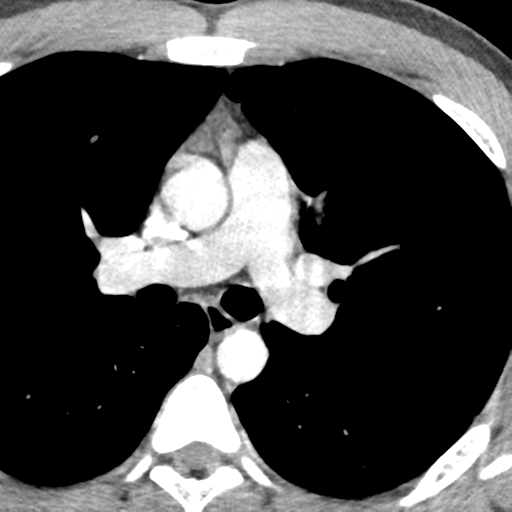 File:Normal CT pulmonary veins (pre RF ablation) (Radiopaedia 41748-44702 A 74).png